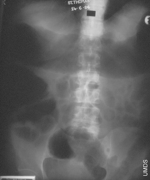 toxic megacolon DriverLayer Search Engine