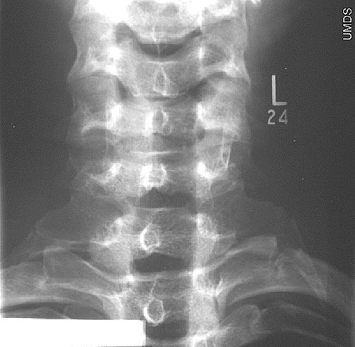 Get Answer Bilateral Cervical Ribs Findings There Are Bilateral