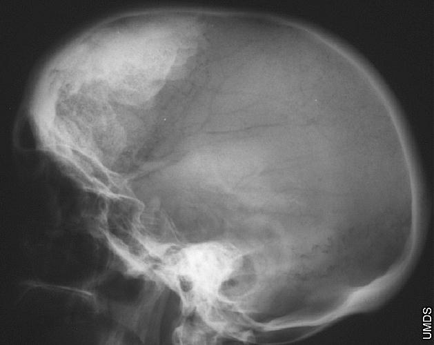 Hyperostosis; Bone Hypertrophy